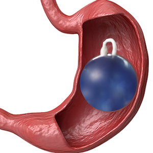 balón gástrico ajustable spatz3 – pérdida de peso no invasiva